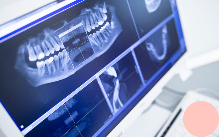 Røntgen av kjeve tilbrukpånett foto Science Photo Library Getty Images